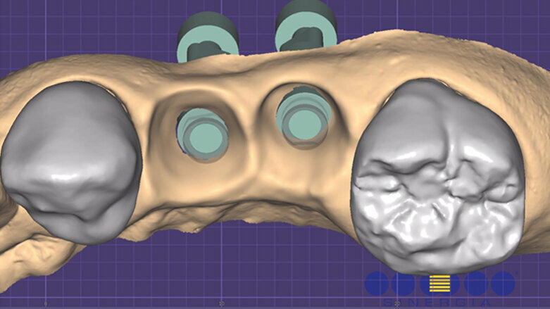 Profili gengivali in protesi: approccio full-digital