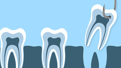 Extraktion dritter Molaren – Welche Probleme treten danach auf?