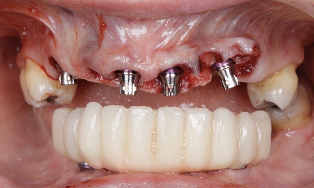 Figs. 61 & 62: Temporary abutments were placed on top of the screw- retained abutments. 