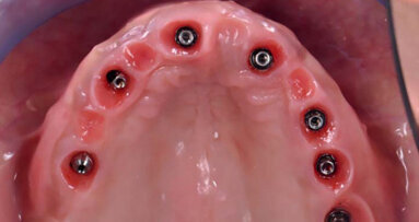 Programme ADF implantologie et radiologie : Penser long terme et progresser dans sa mise en oeuvre