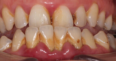 Plaque bacteria prove no match for guided biofilm therapy