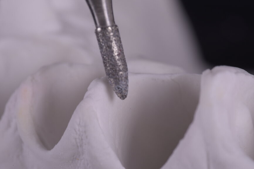 Fig. 65: Cervical contouring for the new cervical design.