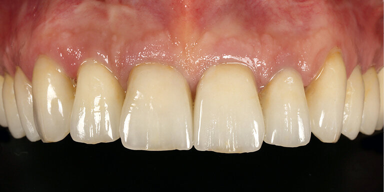 Fig. 25: The preparations were effectively concealed under the new crowns (cut-back method) and the brightness of the teeth was considerably increased.