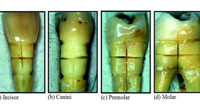 Modification of tooth neck dentin with a diode laser for desensitisation