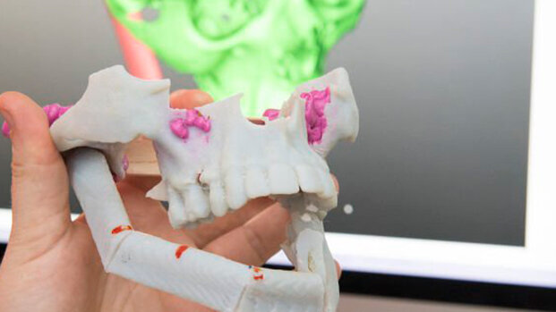 Un congresso internazionale discute le potenzialità della stampa in 3-D in Medicina