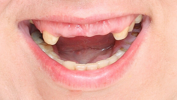 Tooth loss could slow down mind and body functions