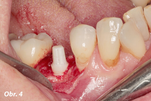 Obr. 4: Umístěný keramický implantát před zašitím