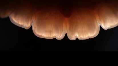 Short fibres, long-term vision: Protecting the tooth, not just the restoration