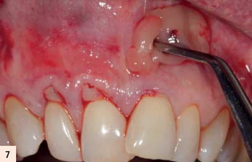 figure 7 : Mise en place d’une membrane d’A-PRF. La technique « distal-mesial backpack » garantit le remplissage total par des membranes d’A-PRF de la poche créée. Trois ou 4 membranes sont recommandées par couple de dents à traiter.