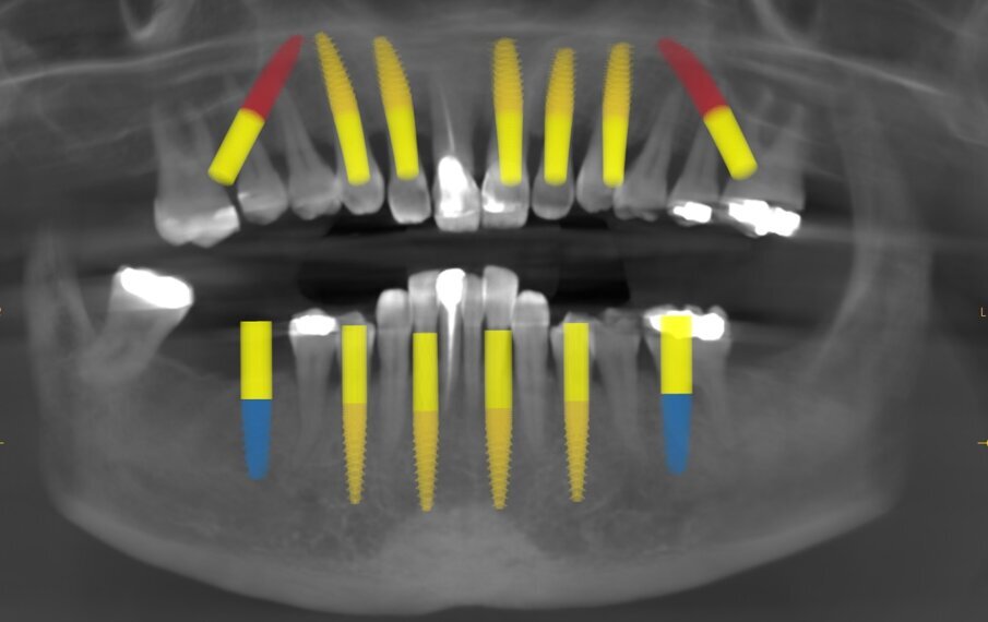 Fig. 4: Planning with the CS 8100 3D device.