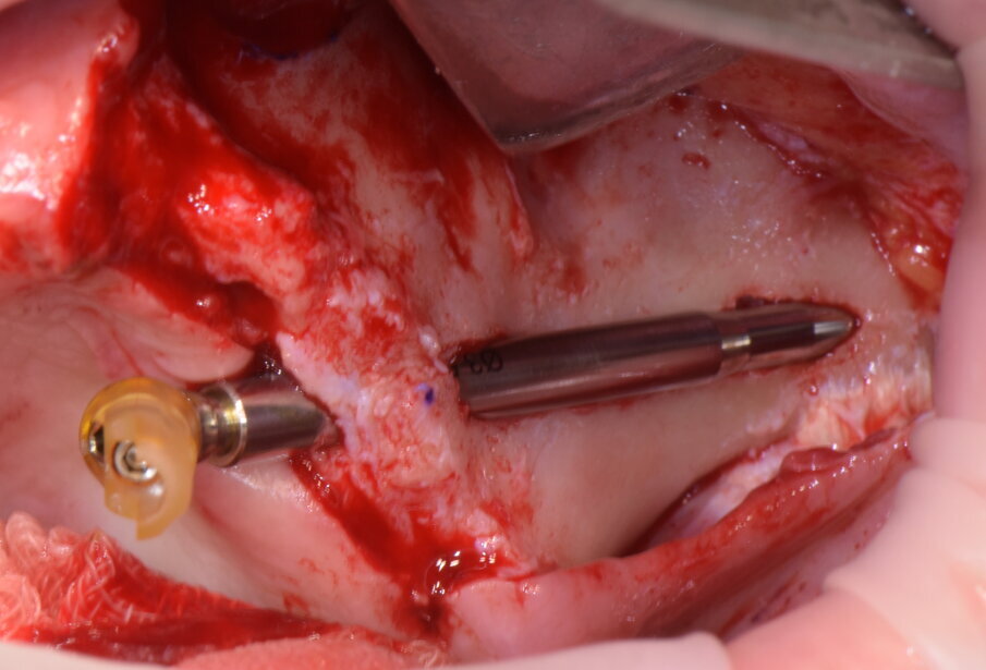 Figg. 18, 19 - Inserimento del demo.