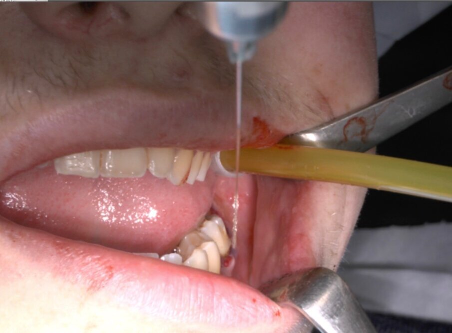 Fig. 15_Lavaggio della ferita chirurgica con PRF per migliorare la guarigione della ferita.