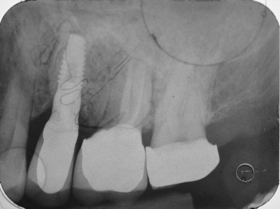 Fig. 13 - RX periapicale endorale.