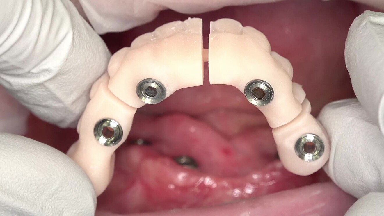 Fig. 7: 3D-printed validator try-in with gaps between implant positions.