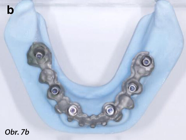 CAD/CAM model s prefabrikovanými titanovými abutmenty (a), CAD/CAM chromkobaltová základní konstrukce (b) a provizorní fixní náhrada fazetovaná kompozitem (c, d) před připevněním na abutmenty.