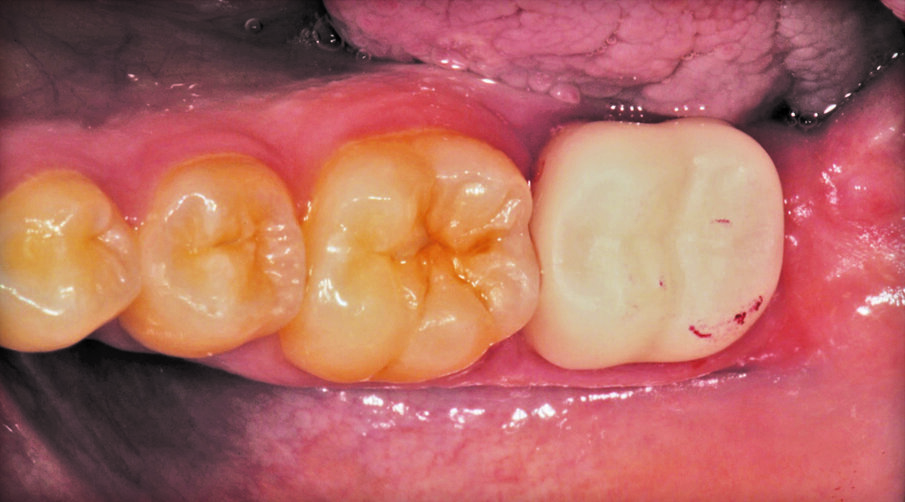Fig. 3: Temporization with 3M™ Protemp™ 4  Temporization Material.