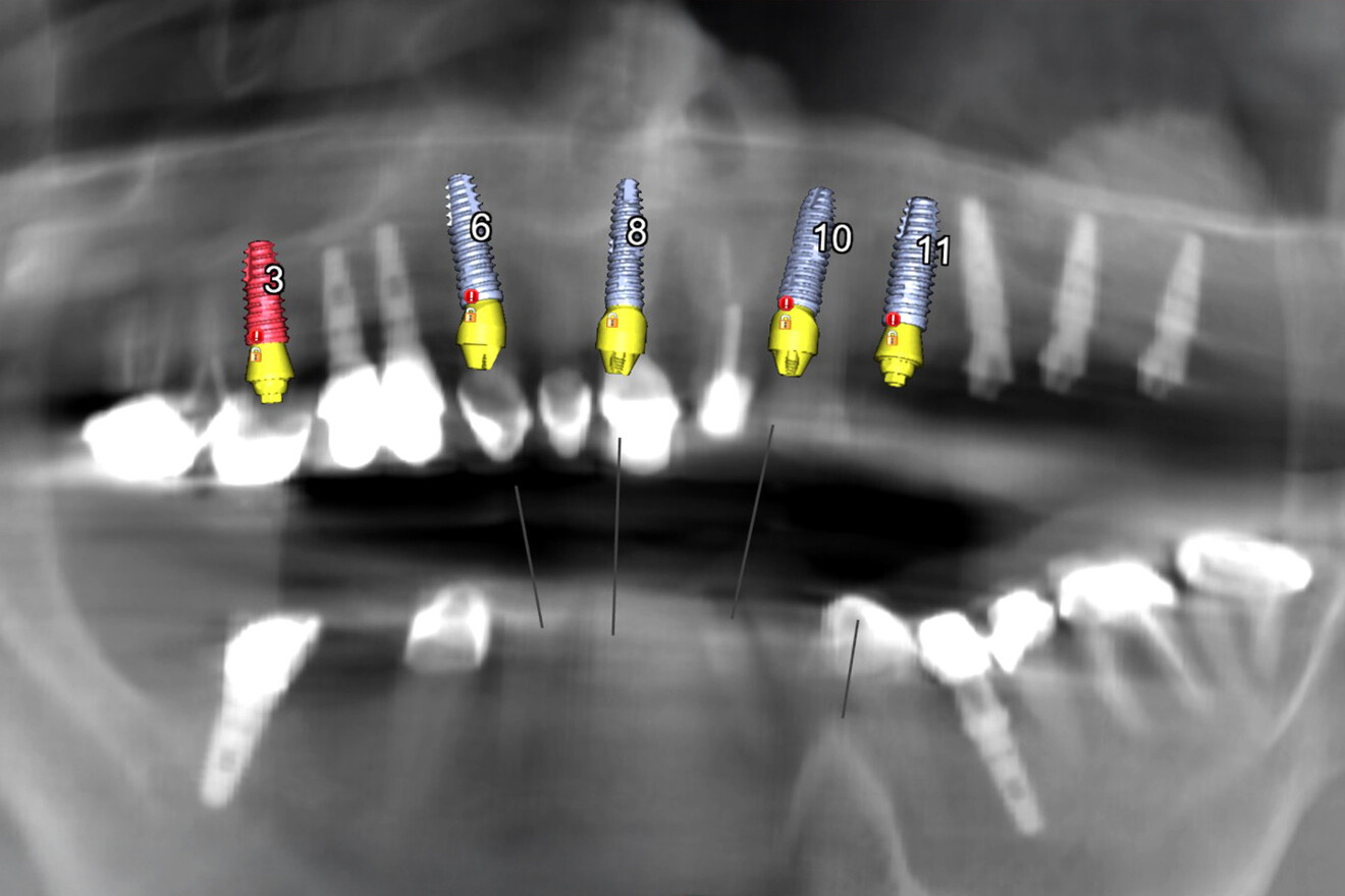 Fig. 4: Simulated implant plan on the panoramic radiograph, illustrating placement of five additional implants, in positions #16, 13, 11, 22 and 23, to achieve cross-arch stability for a full-arch implant-supported restoration.