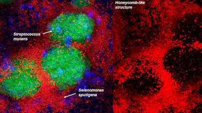 Diş Çürüklerinde Etkili Yeni Bir Bakteri Keşfedildi