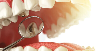 Prevenzione e management non restaurativo delle lesioni cariose