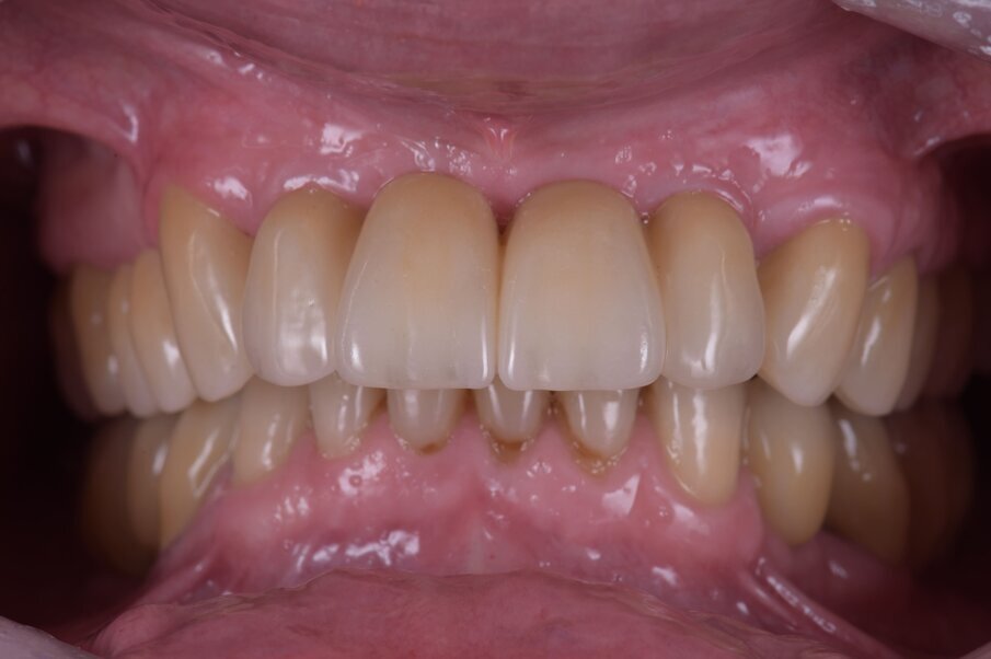 Fig. 46_Anche la cementazione rappresenta un passaggio importante per l’ancoraggio implantare, il controllo di fissazione dei monconi e la corretta rimozione del cemento. 