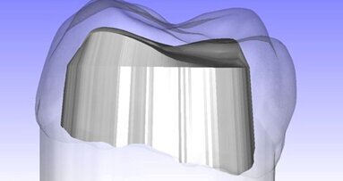 Les chercheurs développent des logiciels pour améliorer la rétention des couronnes dentaires