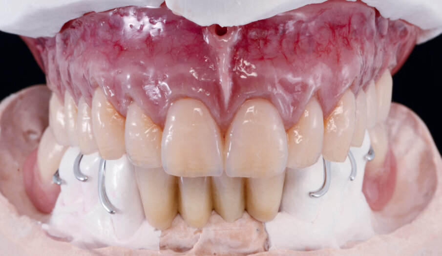Figs: 10. Completed dentures on the upper and lower jaw models.
