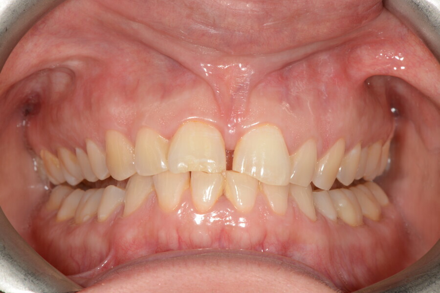 Figs. 3a–c: Deep bite due to lateral tongue interposition at rest and atypical lateral swallowing.