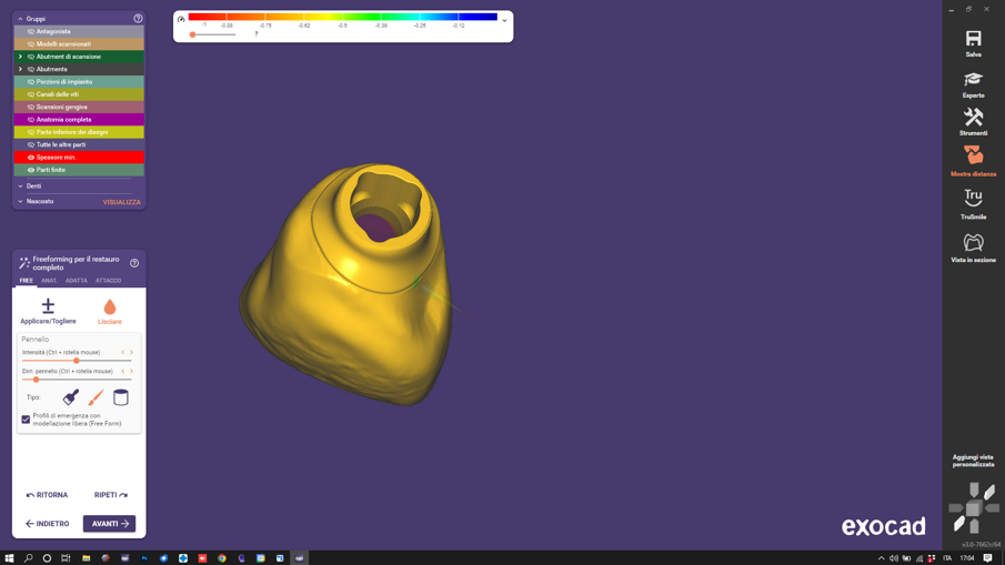 Fig. 5_Corona pronta per essere esportata in STL e stampata, la cava che accoglierà l’Interface/Ti-Base è cosi ottimizzata per il processo di produzione e i materiali scelti e rivalutati durante il processo di progettazione CAD..