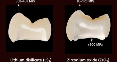 Étude : le disilicate de lithium IPS e.max est le plus matériau céramique le durable testé à ce jour