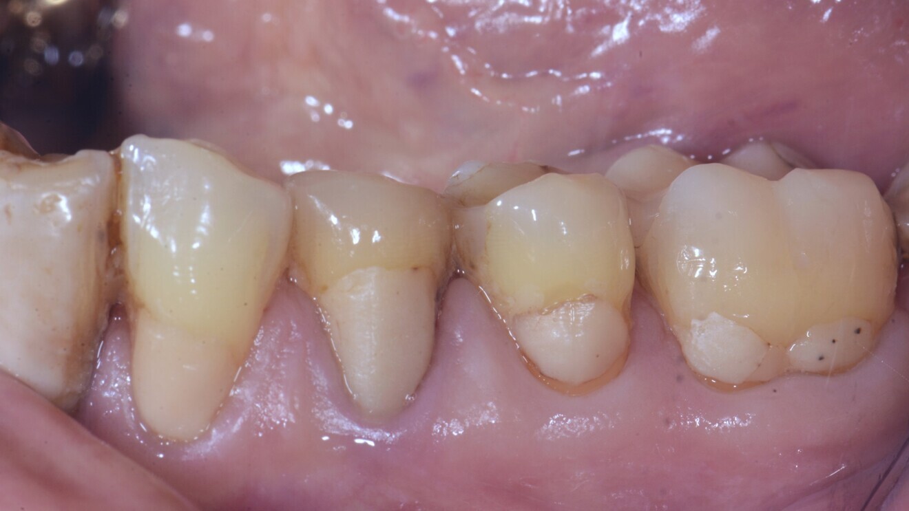 Fig. 3: Glass hybrid restorations at follow-up after 6.5 years. 