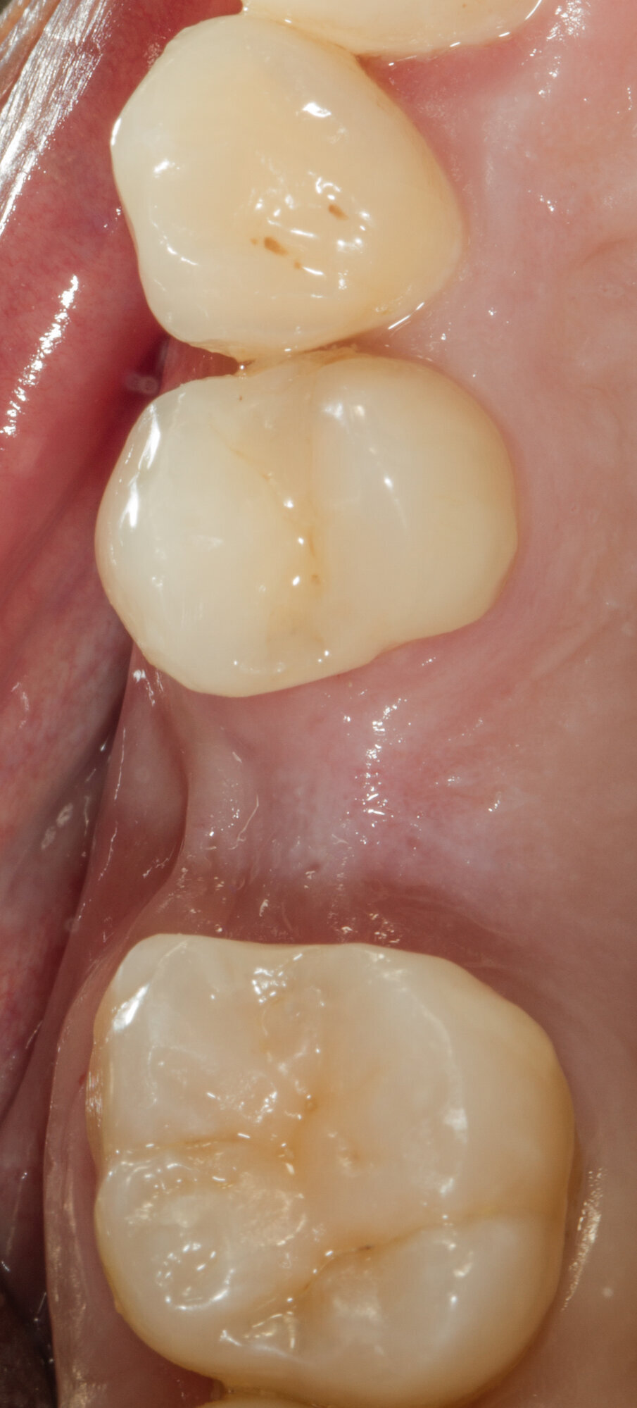 Fig. 16 - Situazione clinica a 10 mesi.