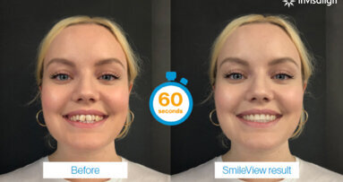 Align takes another step forward in the clear aligner industry