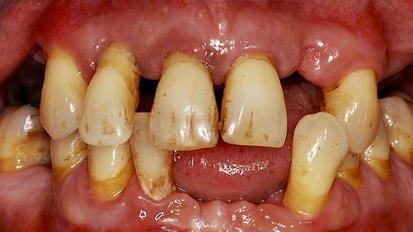 Prävalenzzahlen zu Parodontitis in Österreich „Fehlanzeige“