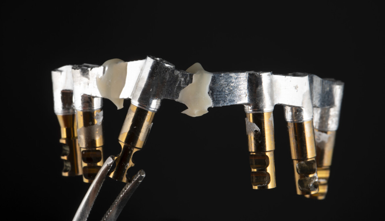 Fig. 3: Aluminium bar after sectioning and splinting to achieve a passive fit.