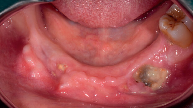 Osteonecrosi delle ossa mascellari (ONJ)