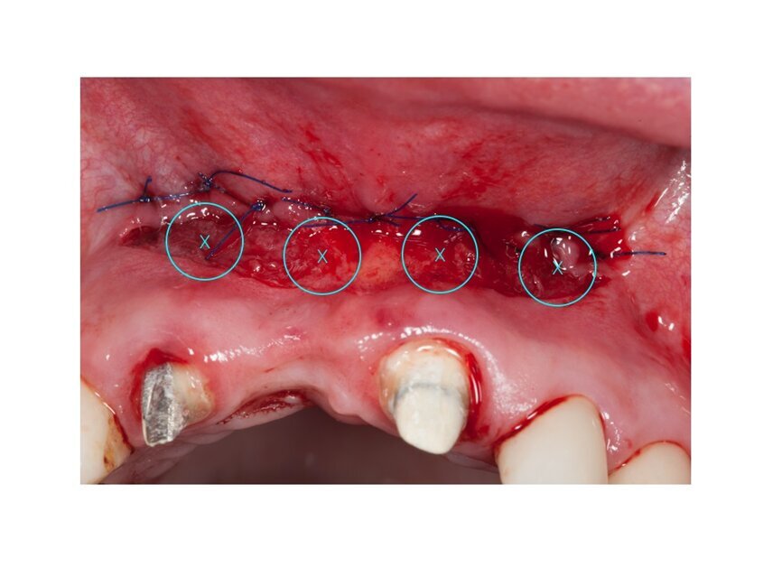 Ryc. 7_Zabieg biomodulacji w 4 punktach.