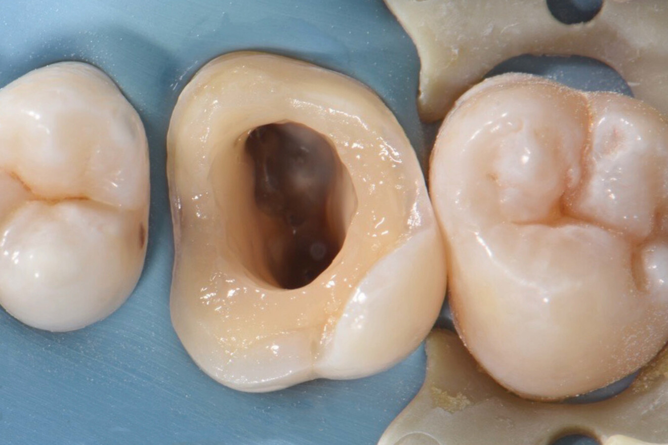 Fig. 21: After application of a universal adhesive to the entire surface and coating of the root canals with flowable composite.