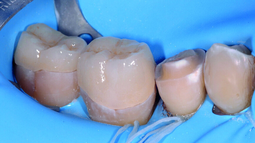 Figs. 10a & b : Essayage