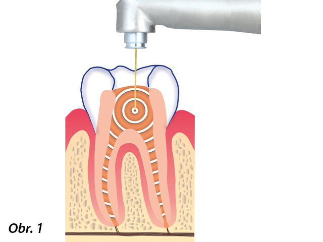 Laserem aktivovaná irigační technika využívající laserovou technologii SSP/SWEEPS® Er:YAG a protokol fotony indukovaného fotoakustického proudění (PIPS). Špička laserové vláknové koncovky je umístěna pouze v koronální části pulpální dutiny a ponechána stacionární, což umožňuje šíření fotoakustických vln do vstupu každého kanálku. To umožňuje minimální rozšíření kanálku při preparaci a přístup bez tepelného poškození, které více hrozí u technik vyžadujících umístění nástroje do systému kanálků.