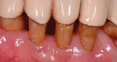 Ruolo delle nicchie ecologiche nell’eziologia dell’alitosi: la lingua tra le principali cause