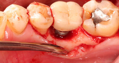 Discovery months: Neodent presents three dental implant education highlights