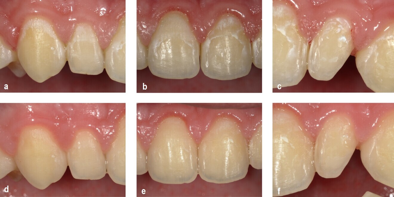 Fig. 1a–f. Fotografii intraorale digitale obținute de la un pacient din grupul de studiu la momentul inițial T0 (a, b, c) și la T2 după 6 luni (d, e, f). Aplicarea complexului F-ACP a demonstrat o reducere semnificativă a vizibilității leziunilor între T0 și T2. După 6 luni, practic nu mai sunt vizibile leziuni de tip WSL după uscarea cu aer timp de 5 secunde.2