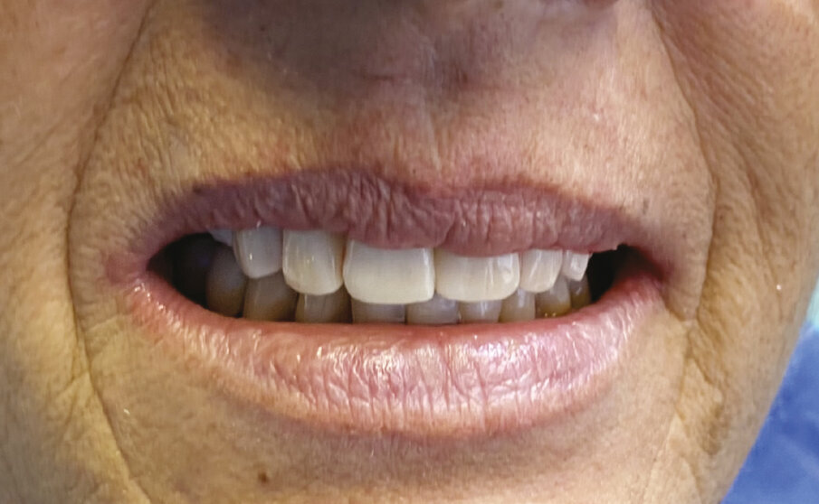 Fig. 8 - Protesi provvisoria tipo Toronto (carico immediato).