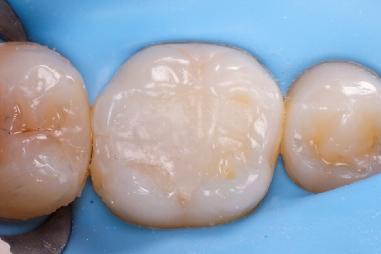 Fig. 3: Dental dam isolation.