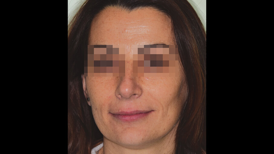 Figg. 8a-8c_Foto extraorali di fine trattamento.