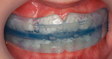 Tooth positioning appliances: An orthodontist’s experience