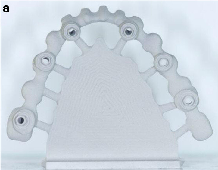 Fig. 13a: CAD/CAM-fabricated one-piece cobalt–chromium framework before (a & b) and after veneering with composite (SR Nexco Paste, Ivoclar Vivadent), that is the final FDP (c & d).