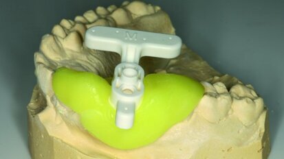 Traitement en une seule visite grâce à la CFAO et la CBCT