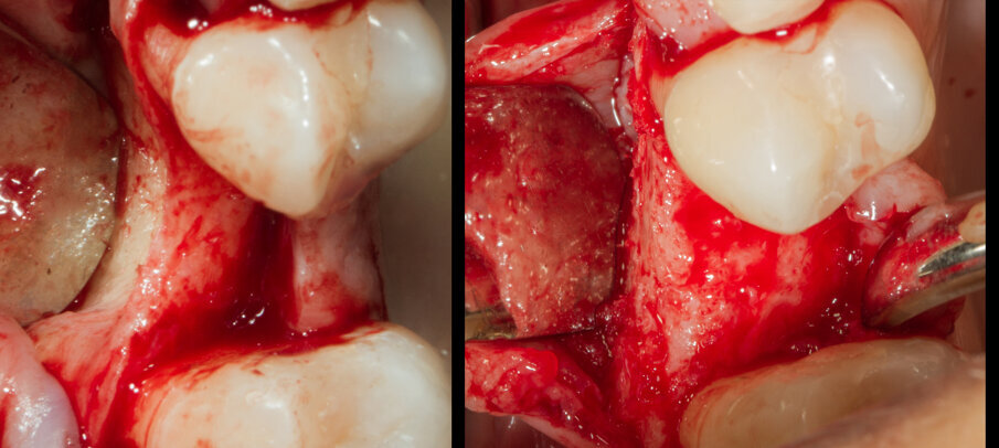Fig. 20 - Confronto occlusale tra baseline e sito rigenerato.