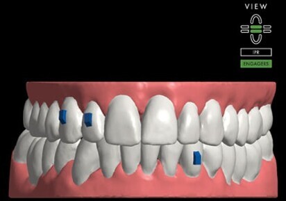 ClearCorrect’s next-generation treatment setup